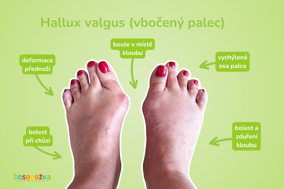 Hallux valgus (vbočený palec)